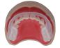 Preview: Aqualizer on upper teeth